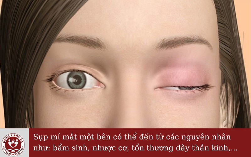 Sụp mí mắt một bên: Nguyên nhân, phương pháp điều trị ảnh 2