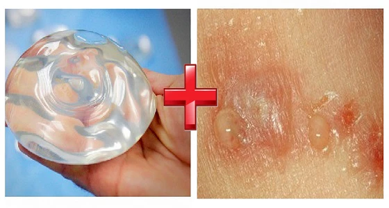 Miếng dán silicon: đẹp vòng 1 và đầy ẩn hoạ chết người