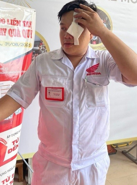 Nam kỹ thuật viên cảm thấy rát và nóng ran ở mắt, vùng mắt đỏ và sưng lên sau khi trúng nọc độc của rắn. May mắn là sau đó người này được đưa tới phòng khám xử lý kịp thời, uống thuốc và rửa mắt nên sức khỏe ổn định. Người này cũng được bác sĩ kê đơn thuốc để uống. Ảnh: Ảnh: NVCC.