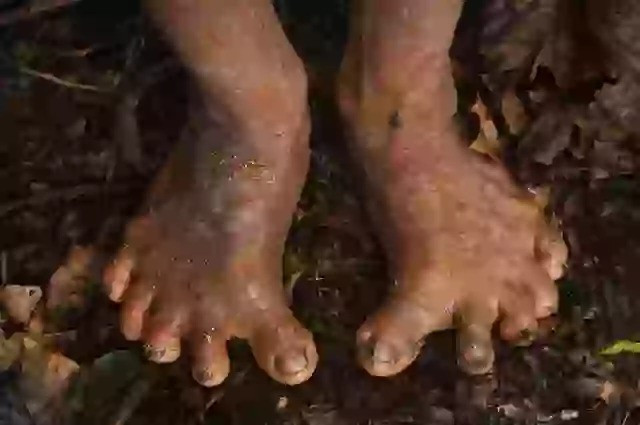 Theo đó, đa số người Huaorani có bàn chân dẹt. Một số người có bàn chân và bàn tay có 6 ngón. Đặc điểm cơ thể này được cho là giúp họ trèo cây dễ dàng hơn. Ảnh: Pete Oxford/Media Drum World.