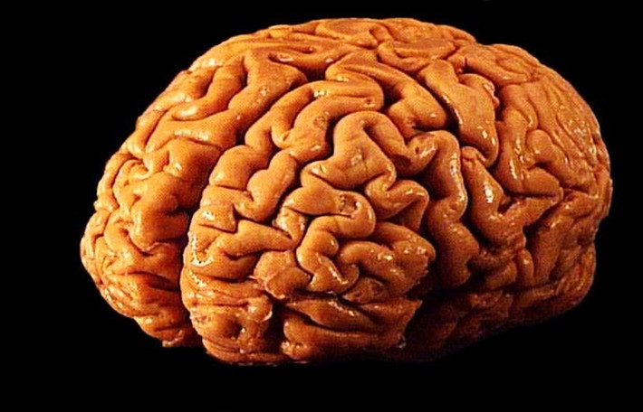 Nghiên cứu mới tập trung vào dị tật Chiari type I (CM-I), trong đó phần dưới của não kéo dài quá mức vào tủy sống, thường liên quan đến việc xương chẩm ở phía sau hộp sọ nhỏ hơn bình thường. Ảnh: aboutmodafinil.com | Flickr Creative Commons.