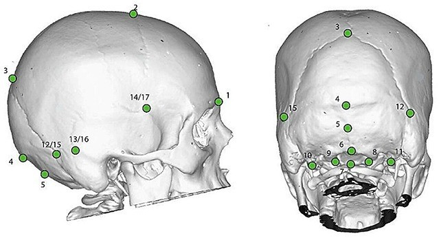 Nghiên cứu của các chuyên gia tập trung vào dị tật Chiari - tình trạng bẩm sinh, đặc trưng bởi việc một phần mô não bị sa xuống do khiếm khuyết nằm ở phần phía sau của hộp sọ. Ảnh: Plomp et al., Evol. Med. Public Health, 2025.