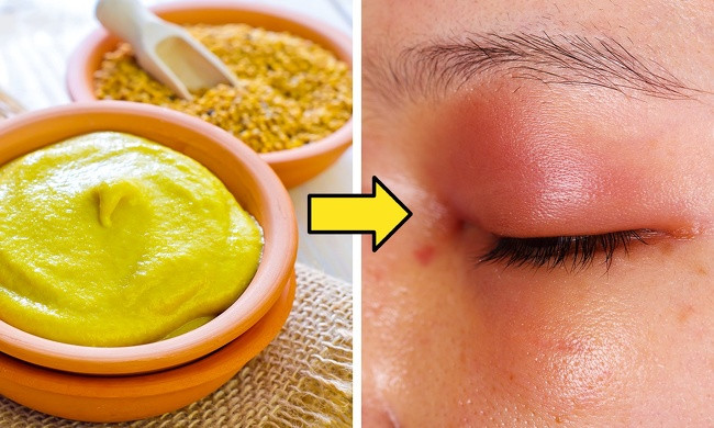 3. Sử dụng mặt nạ hỗn hợp: Với nhiều thành phần khác nhau tạo thành mặt nạ tuy nhiên có thể gây ra các vấn đề như: bỏng, đỏ, dị ứng da và nổi mày đay.