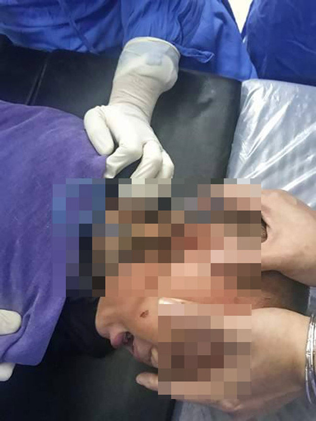 Bé trai bị cắm kéo vào tai: Ngày 20/6/2017 trong lúc mẹ đang dọn dẹp bỗng thấy con trai mình gọi thất thanh, chạy vào thì thấy chiếc kéo hoen gỉ đâm sâu vào tai. Gia đình đã đưa ngay bé vào bệnh viện tai mũi họng và bé đã qua cơn nguy kịch.