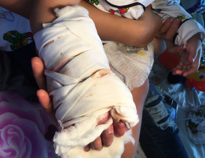 Bé trai bị thang cuốn kẹp dập nát cổ bàn tay: Sáng 7/4/2017, Bệnh viện Chấn thương chỉnh hình, TP.HCM cho biết đã phẫu thuật vết thương dập nát cổ bàn tay phải cho bệnh nhi V.N.T.P (17 tháng tuổi) bị thang máy ở sân bay Tân Sơn Nhất cuốn vào chiều 6/4. Trước đó, hai mẹ con chị N. đã làm thủ tục chuyến bay và vào phòng chờ đợi bay đi Đồng Hới khởi hành lúc 17h30. Trong thời gian chờ, cháu P. tự chạy đi chơi và ngã xuống thang cuốn cảm ứng tự động, bị kẹp cổ tay phải.