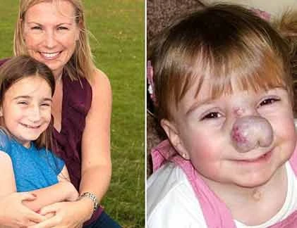 Bé gái có chiếc mũi đáng sợ vì khối u mạch máu