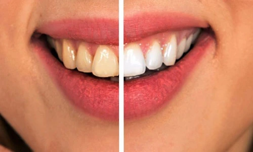 8 cách đơn giản ngừa sâu răng không cần dùng thuốc