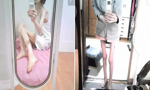 Thiếu nữ như "bộ xương di động" khiến dân mạng phát hoảng