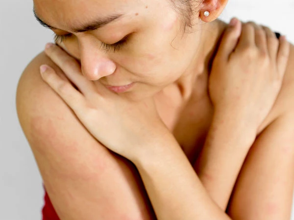 Cách trị mẩn đỏ trên cơ thể hiệu quả không cần dùng thuốc