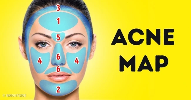 Đoán bệnh chuẩn từ vị trí mọc mụn trứng cá trên mặt