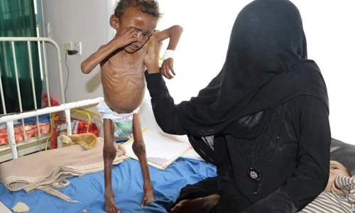 Xót xa chùm ảnh về nạn đói khủng khiếp ở Yemen