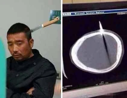 Bị dao găm vào não, vẫn bình thản đi bộ tới viện 