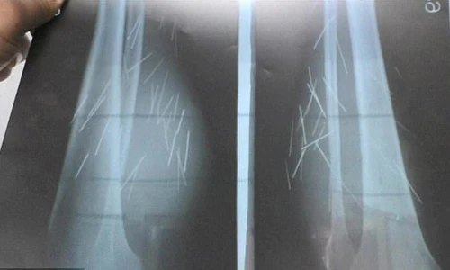 Kinh hoàng góa phụ “mọc” hàng chục cây kim từ... bắp chân 