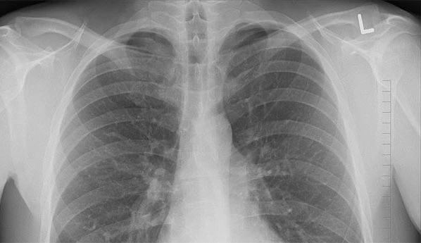 Điều bất ngờ về bệnh lao có thể bạn chưa biết