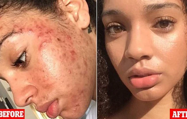 Tuyệt chiêu chữa mặt mụn chi chít sạch láng mịn chỉ trong 30 ngày
