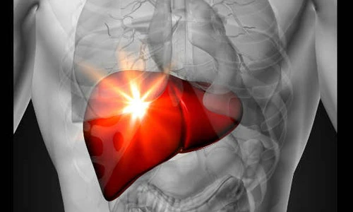 Có dấu hiệu này chứng tỏ bạn đang bị gan nhiễm mỡ