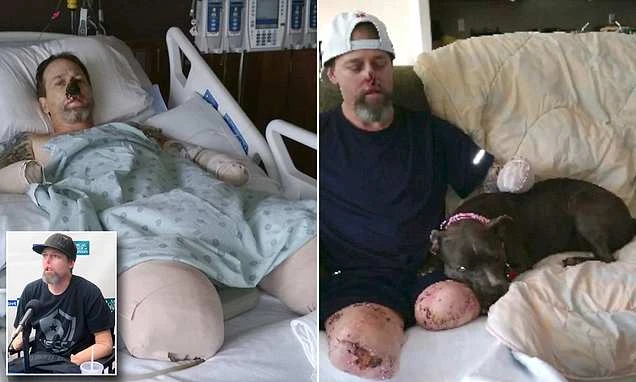 Bị chó liếm chân, người đàn ông cụt tay cụt chân vĩnh viễn