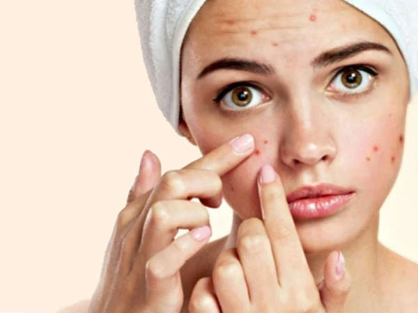 Ăn những thực phẩm này không bao giờ bị mụn trứng cá