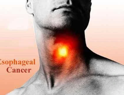 Bốn thói quen ăn uống gây ung thư thực quản