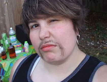 Khi phụ nữ mọc ria mép