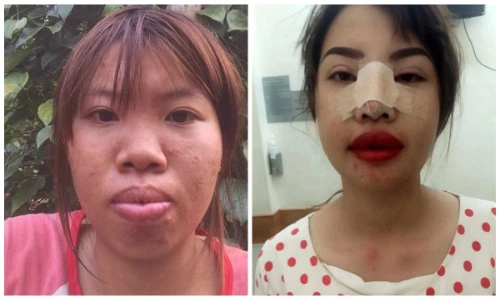 Mẹ đơn thân ở Đăk Nông phẫu thuật thẩm mỹ vì xấu xí