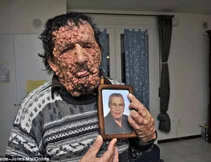 Biến dạng kinh hoàng vì khối u