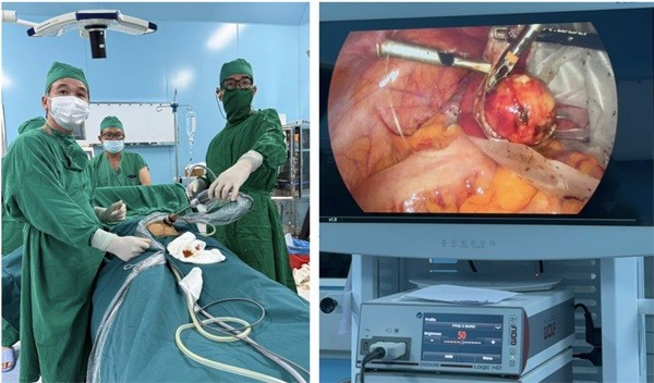 Thực hiện phẫu thuật nội soi cắt bướu quái buồng trứng cho bệnh nhân P.T.Q ngay tại Côn Đảo. Ảnh: SYT con-dao-1.jpg