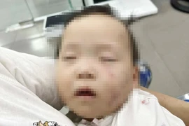 Bắc Ninh xác minh bé gái 1 tuổi bị bầm tím mặt khi đi học