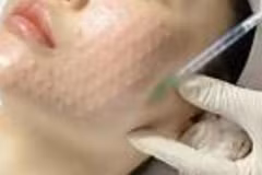 Cẩn trọng với 'bẫy' làm đẹp siêu tốc cận Tết