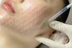 Cẩn trọng với 'bẫy' làm đẹp siêu tốc cận Tết