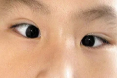 Chứng lác mắt ở trẻ tăng do sử dụng thiết bị điện tử