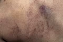 Cô giáo đã thừa nhận hành vi đánh bé gái 4 tuổi ở Hà Nội