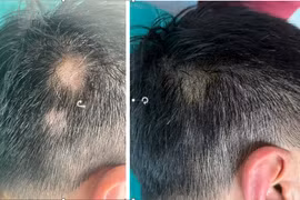 Tóc rụng từng mảng, bác sĩ mách cách chữa hiệu quả