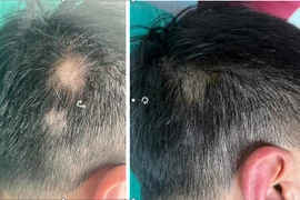 Tóc rụng từng mảng, bác sĩ mách cách chữa hiệu quả