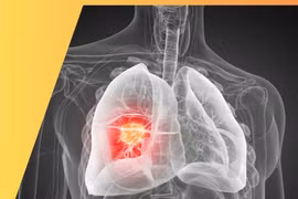 Đừng bỏ qua các thông tin cảnh báo ung thư phổi, điều trị đích