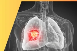 Đừng bỏ qua các thông tin cảnh báo ung thư phổi, điều trị đích