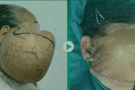 Thoát khỏi khối u khổng lồ đeo bám trên mặt suốt hơn 40 năm