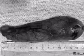 Nuốt nghẹn không ngờ u mỡ thực quản khổng lồ