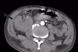 Đau thắt lưng, sốt, người bệnh nguy kịch vì viêm bể thận