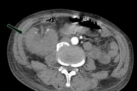 Đau thắt lưng, sốt, người bệnh nguy kịch vì viêm bể thận