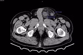 Chủ quan với khối thoát vị bẹn người đàn ông bị hoại tử đại tràng