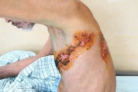 Cảnh báo biến chứng nguy hiểm do zona thần kinh