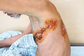 Cảnh báo biến chứng nguy hiểm do zona thần kinh