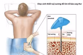 Dấu hiệu nhận biết sớm bệnh xơ tủy