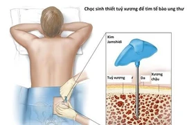 Dấu hiệu nhận biết sớm bệnh xơ tủy