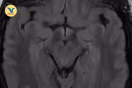 Nhìn mờ chỉ định chữa mộng mắt không khỏi, hóa ra huyết khối tĩnh mạch não