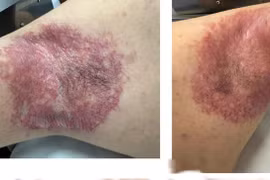 Tiêm botox điều trị cho người bệnh 6 năm nứt da, rỉ dịch đau đớn