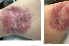 Tiêm botox điều trị cho người bệnh 6 năm nứt da, rỉ dịch đau đớn