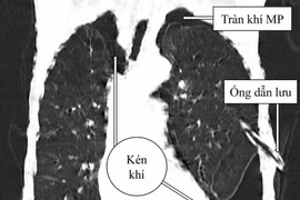 Tràn khí màng phổi phức tạp do kén khí vỡ
