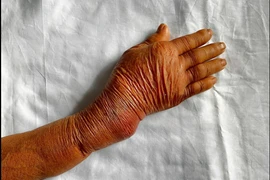 Cảnh báo bó thuốc nam chữa gãy xương, lợi bất cập hại